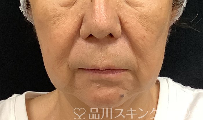 症例NO.67983のBEFORE写真