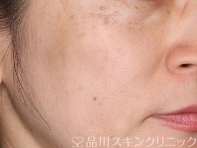 症例NO.75214のAFTER写真
