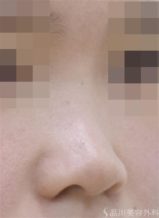 症例NO.50691のBEFORE写真