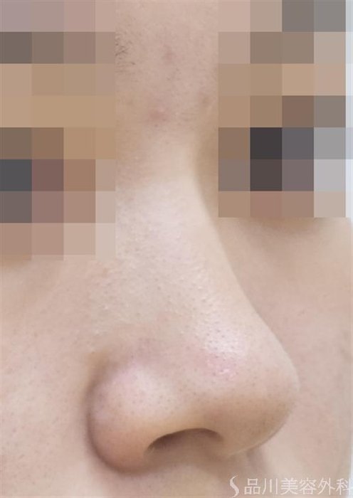 症例NO.52914のBEFORE写真