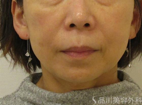 症例NO.48039のAFTER写真