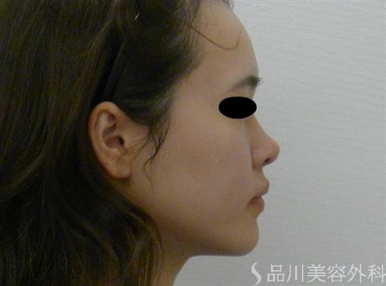 症例NO.39800のAFTER写真