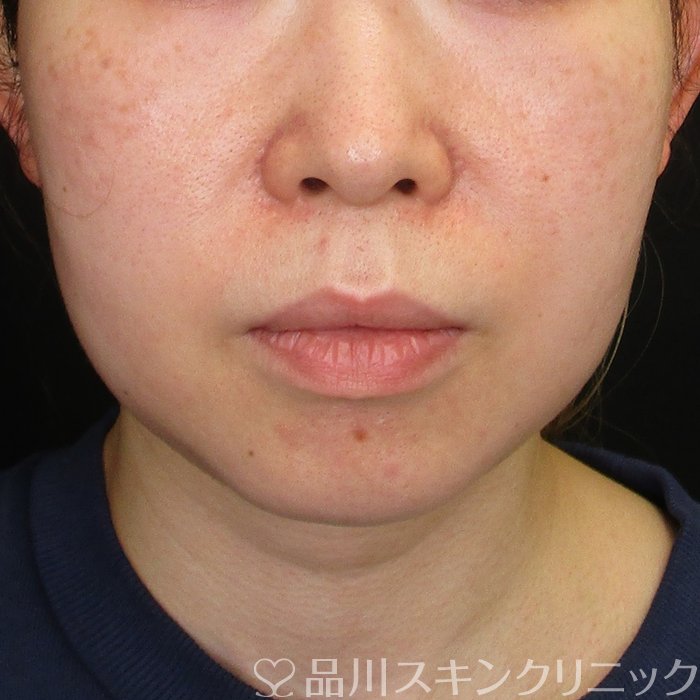 症例NO.73901のBEFORE写真