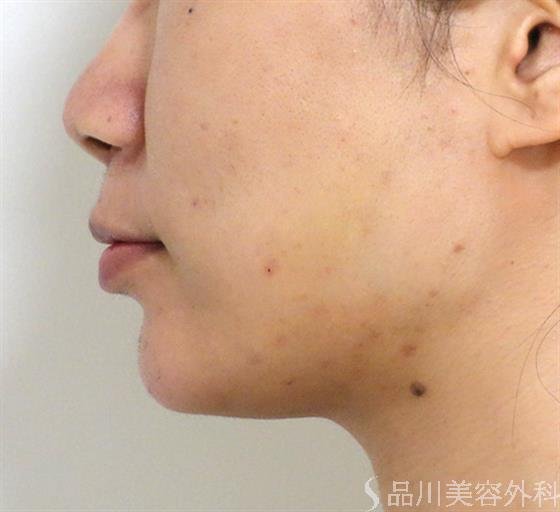 症例NO.35168のAFTER写真