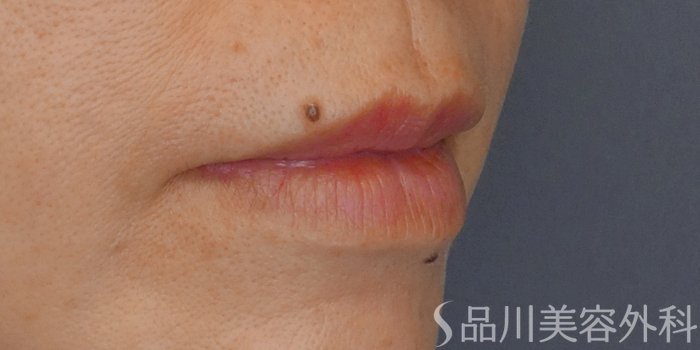 症例NO.71645のBEFORE写真