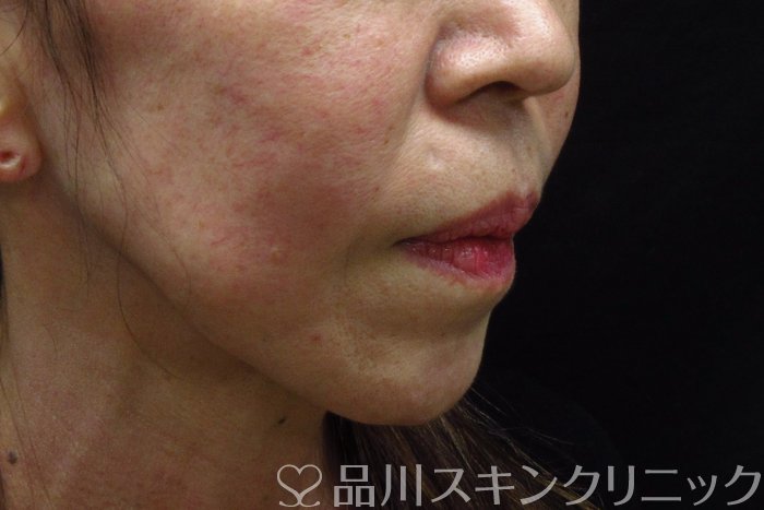 症例NO.74318のBEFORE写真