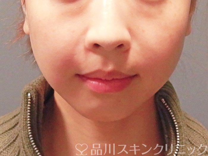 症例NO.63155のAFTER写真