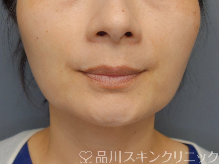 症例NO.70967のBEFORE写真