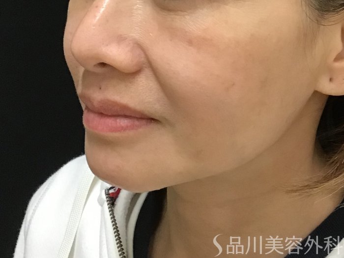 症例NO.69701のBEFORE写真