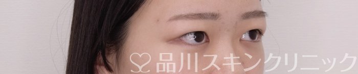 症例NO.69372のBEFORE写真