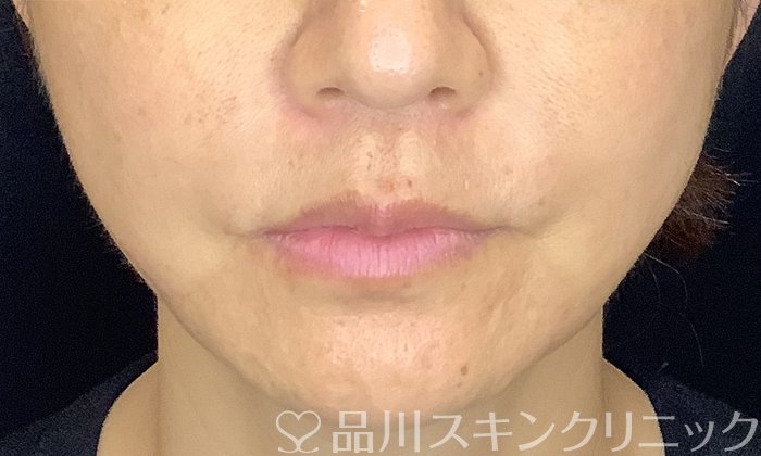 症例NO.71842のAFTER写真