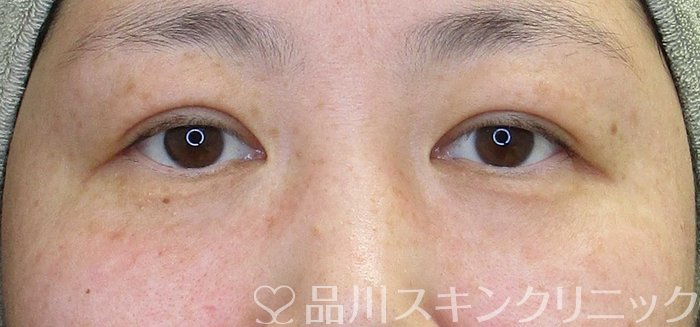 症例NO.69723のAFTER写真
