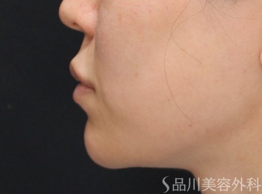 症例NO.74949のBEFORE写真