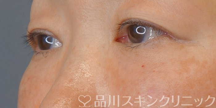 症例NO.72559のAFTER写真