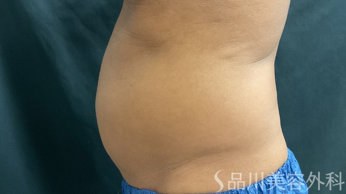 症例NO.75369のBEFORE写真