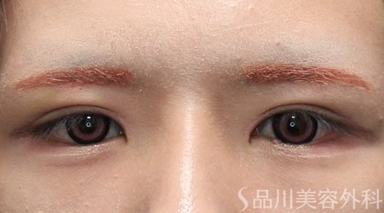 症例NO.75213のAFTER写真