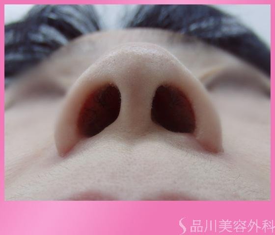 症例NO.1242のBEFORE写真