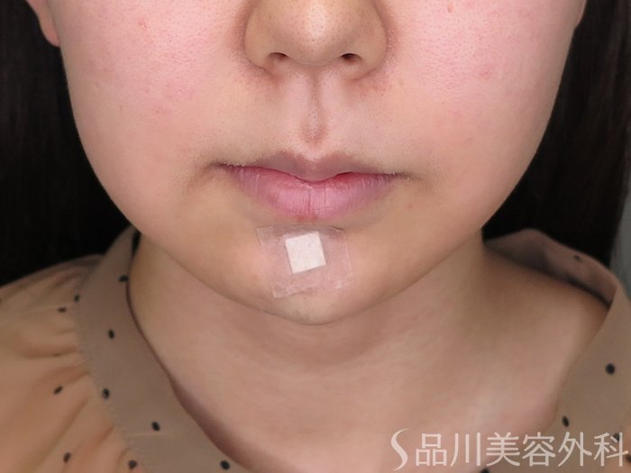 症例NO.71299のAFTER写真
