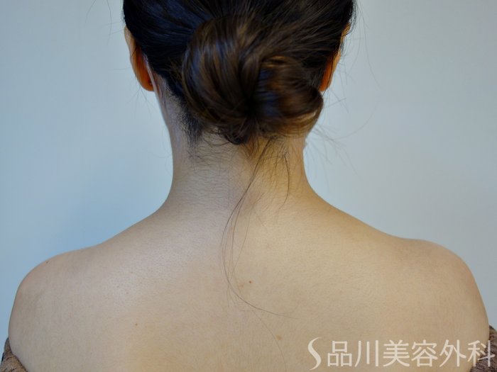 症例NO.73548のBEFORE写真