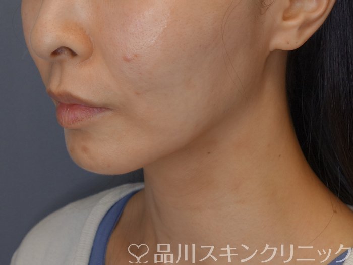 症例NO.71717のAFTER写真