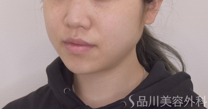 症例NO.64450のBEFORE写真