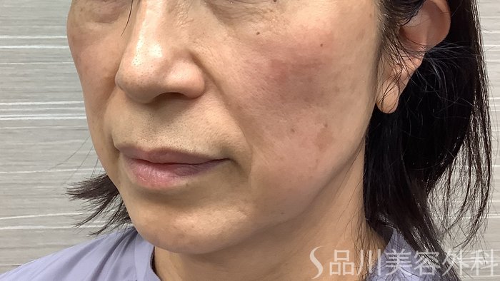 症例NO.62222のBEFORE写真
