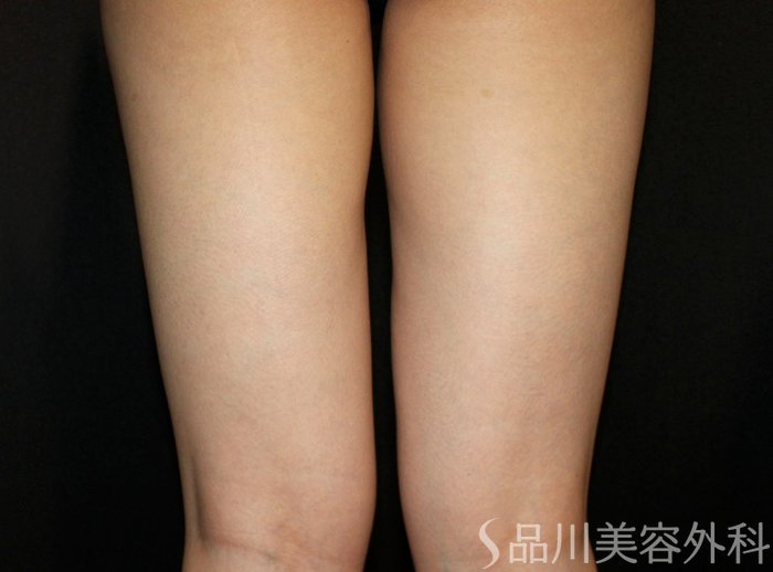 症例NO.73720のAFTER写真