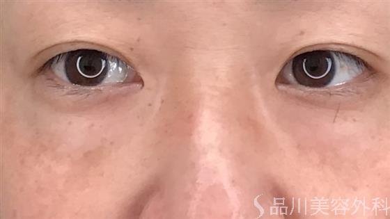 症例NO.56397のBEFORE写真