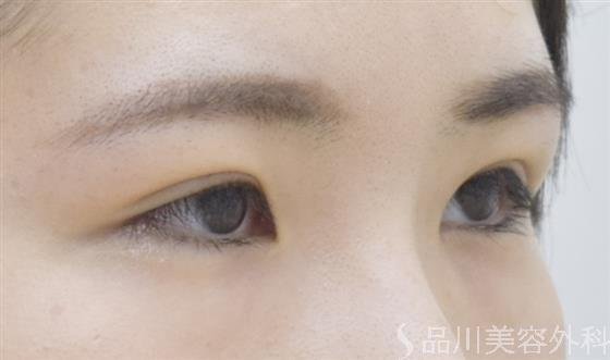 症例NO.54040のAFTER写真
