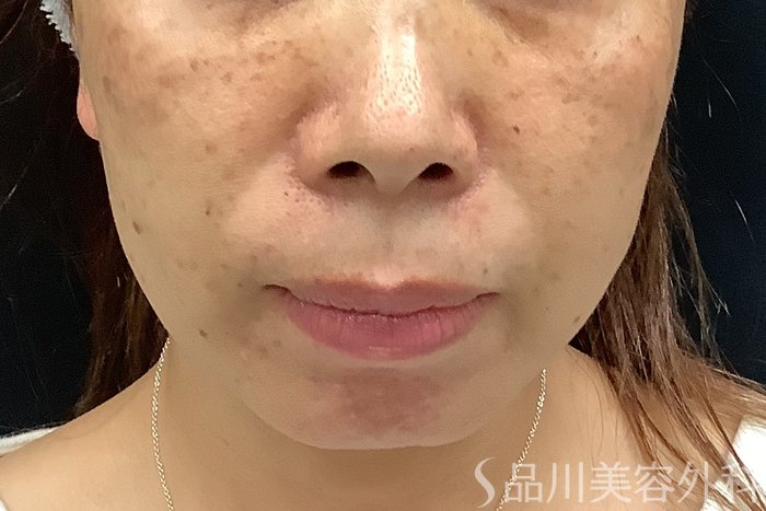 症例NO.67807のBEFORE写真