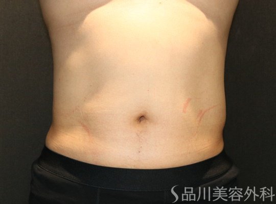 症例NO.72304のAFTER写真