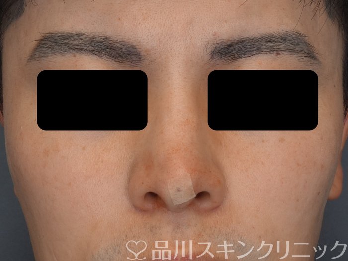 症例NO.74675のAFTER写真