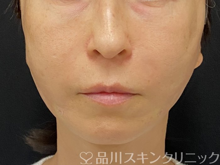 症例NO.74819のAFTER写真