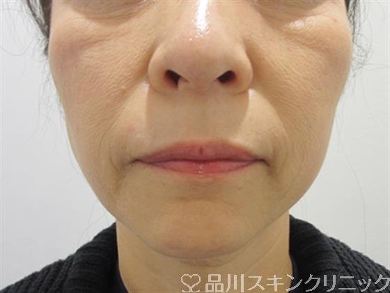 症例NO.42825のAFTER写真