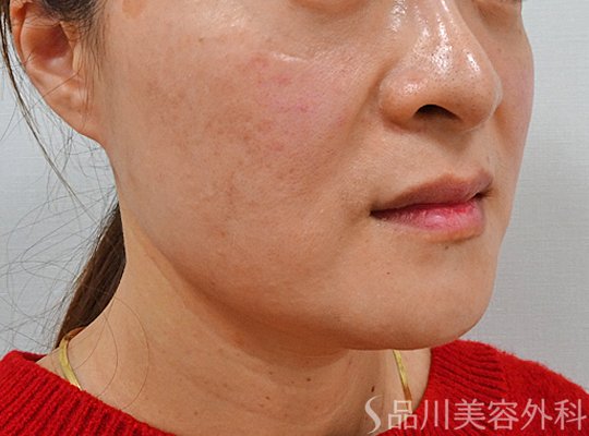 症例NO.73698のBEFORE写真