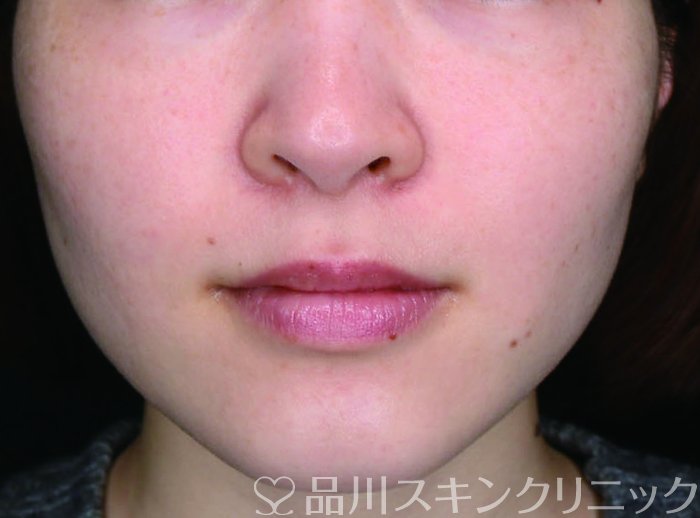 症例NO.72951のAFTER写真