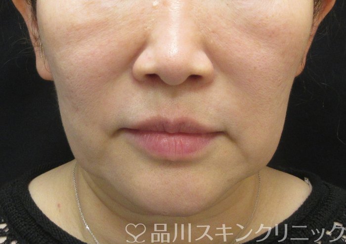 症例NO.73953のBEFORE写真