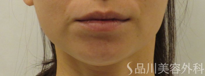 症例NO.70897のBEFORE写真