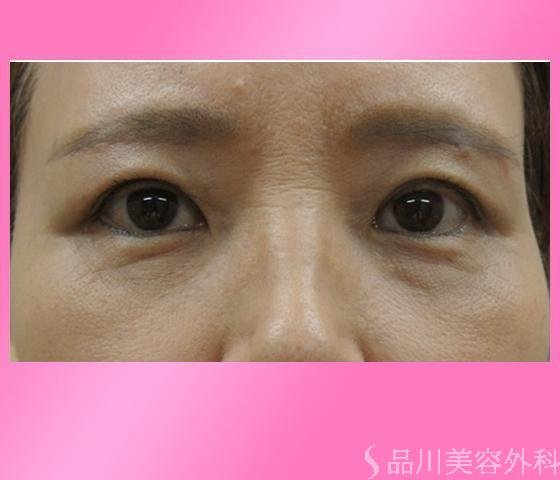 症例NO.14482のAFTER写真