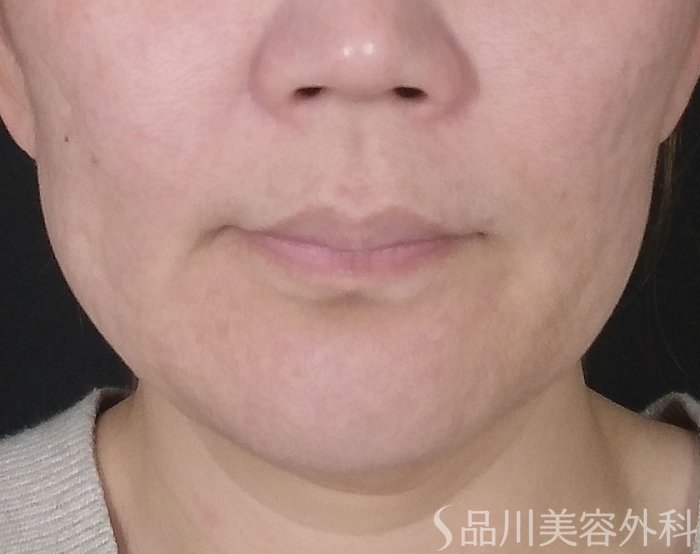 症例NO.67879のBEFORE写真