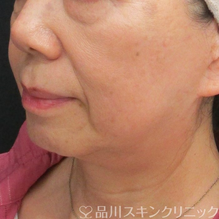 症例NO.75120のBEFORE写真
