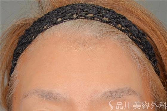 症例NO.54764のBEFORE写真