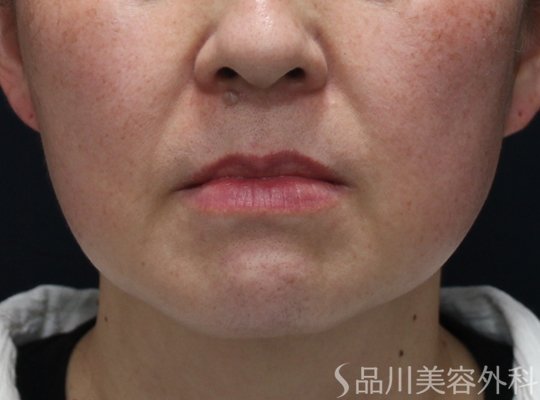 症例NO.74743のBEFORE写真