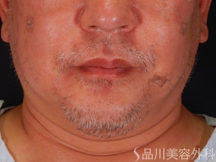 症例NO.69854のBEFORE写真