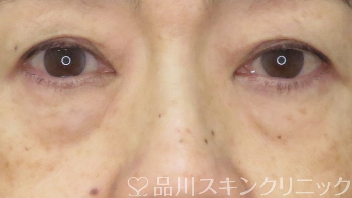 症例NO.71222のBEFORE写真