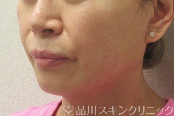 症例NO.72768のAFTER写真