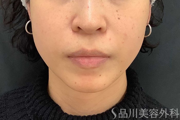 症例NO.69519のAFTER写真