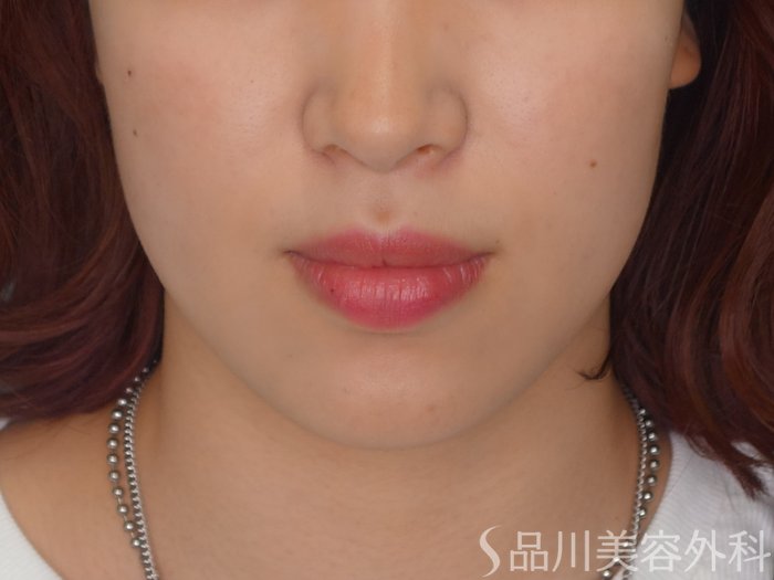 症例NO.69737のAFTER写真
