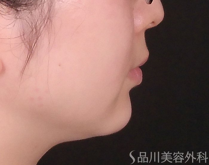 症例NO.69476のAFTER写真