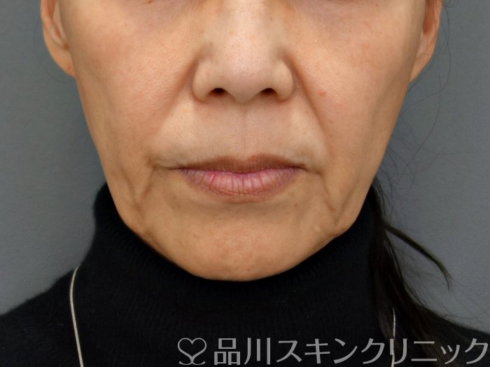 症例NO.74164のBEFORE写真